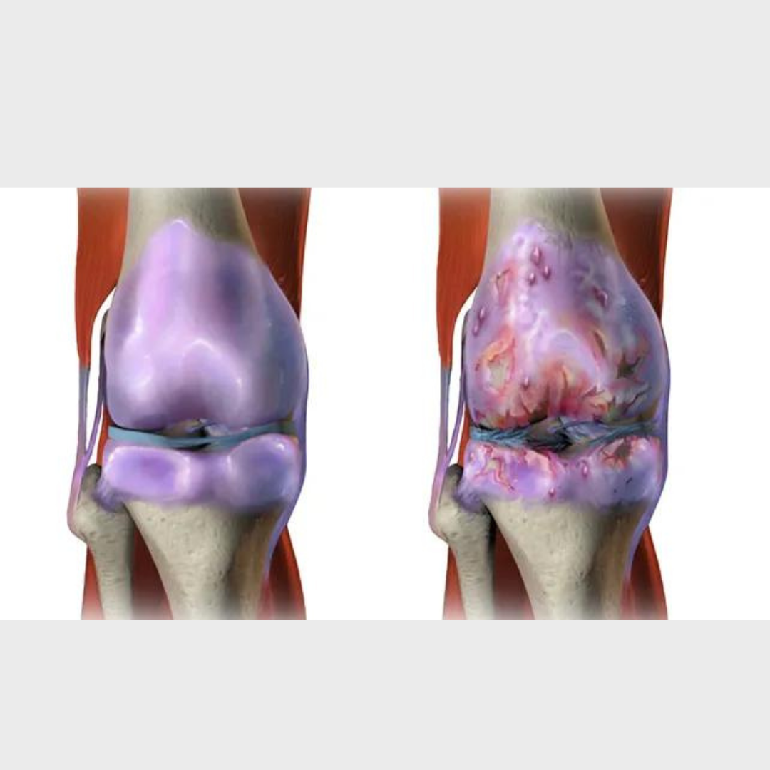 osteoarthritis